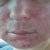 Day 4 after ePrime procedure
