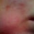 Day 36 after ePrime procedure