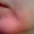 Day 36 after ePrime procedure