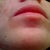 Day 55 after ePrime procedure