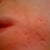 Day 55 after ePrime procedure