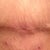 7wks PO and it looks so much better!