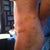 side view, lots of bruising where flanks were lipo'd.
