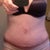 19 DPO...it's early but I think the scar will smooth out well :-) my belly button makes me laugh but I'll give it time