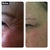 Before and after crows feet