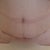 2 1/2 weeks PO- staples are gone.  Scar scab is starting to peel off.  It itches.....