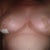 week 6 small opening on right boob but healing up