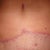 11 weeks PO! Close up of scar.  Fading nicely, crooked though it is.