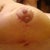 Close ups, 11 days post op