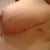 Close ups, 11 days post op