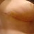 Close ups, 11 days post op