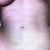 tummy coming together. if i lay on it for a few hours it become flat. belly button looks weird but i dont care lol