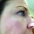 2 weeks post-fraxel #2. I am really, really hoping that as my skin heals this gets better - because it has seemed worse than when I started the past couple of days.