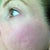 2 weeks post-fraxel #2. I am really, really hoping that as my skin heals this gets better - because it has seemed worse than when I started the past couple of days.
