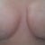 the dent at 19 days
