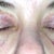 Day 9 upper eyelid suture lines. I am not real happy with the way they look. I hope they will heal to a thinner and flatter line