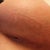 Small hole where Dr opened the incision to drain. Notice the black in the hole..yeah, that's the implant. Not happy at all.