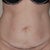 pre-op pic front view