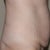 pre-op side view