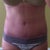 9 weeks 2 days, scar. I kind of like it?? It's so low, and not as bad as I was expecting. Vertical doesn't bother me.