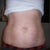 Front view pre-op tummy tuck