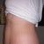 Other side pre-op tummy tuck