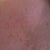 92hrs left side - you can see that the dead skin has not completely peeled off yet. yuck!