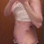 Five day po side view bruising from lipo. Obviously swelling going on here too.