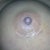Right incision 2 weeks