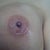 Left incision 2 weeks