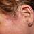 Hair transplant performed 6-months after revision surgery to further camouflage scars from botched surgery at Renaissance Surgical Clinic.  Cost of hair transplant $5,000 plus travel.