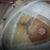 Incision at right one