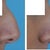 The profile morph Dr. Shah made. The one for the front looked mostly the same other than straightening out of the nose, and he said that it was hard to show the differences via morph, so I left it out.