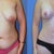 Before surgery and 1 month after. You can tell my left was my 'superboob' - the one that made the most milk and therefore the babies preferred it!  Marks on either side of belly button are from surgical tape.