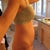 2 weeks post-op side-view.  Pic taken late in day- swollen and bloated but no bulge!