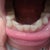 Bottom teeth - Tray#1; severe crowding