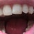 Top teeth- Tray#1; minor crowding but there is a gap on the left side that should be closed with an implant by the end of the Invisalign treatment