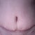 My scar, one month post-op