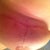 T incision 1 month left