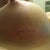 post op day 9 scar left boob