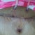 May 26th close up of the incision and drainage tubes.