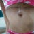 May 26th, removed gauze from belly button.