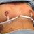 here i am after surgery everything taken away