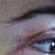 Scar under right eye.