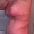 40 days post op - side view