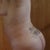 4 weeks post op