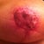 6 weeks post op.  Stiches removed.  Small area where scab came off after shower.  You can see the indent a little from where the gause was. Can't believe the dramatic change!
