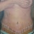 3 Days Post Op