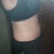 17 Days Post Op