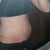 17 Days Post Op
